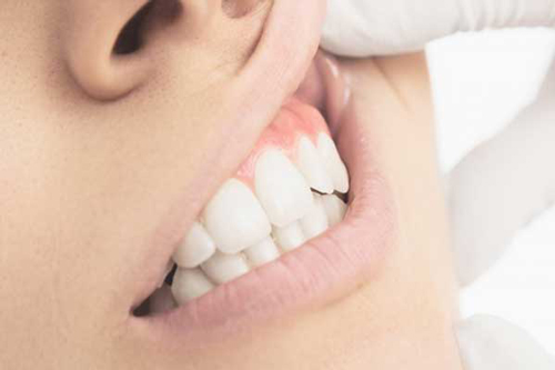 dentista-foligno-spello-parodontologia-02